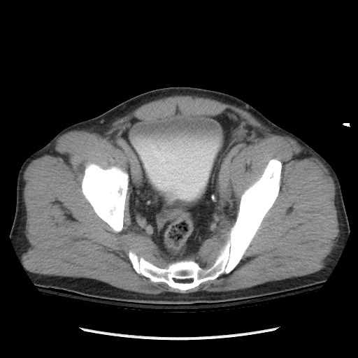 File:Blunt abdominal trauma with solid organ and musculoskelatal injury with active extravasation (Radiopaedia 68364-77895 Axial C+ delayed 119).jpg
