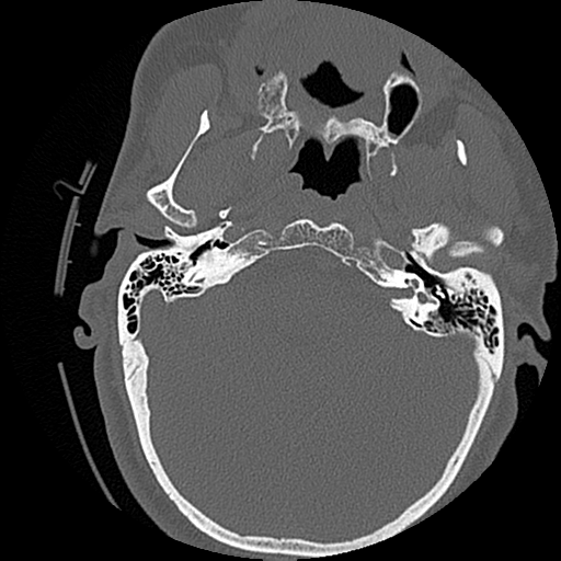 File:Blunt cerebrovascular injury (Radiopaedia 53682-59743 Axial bone window 6).png