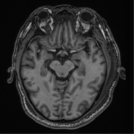 File:Blunt cerebrovascular injury (Radiopaedia 53682-59745 Axial T1 14).png
