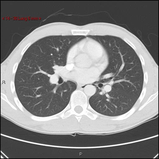Blunt chest trauma - pulmonary interstitial emphysema and pneumomediastinum (Radiopaedia 20666-20552 Axial lung window 30).jpg