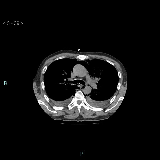 Boerhaave syndrome (Radiopaedia 27683-27897 Axial non-contrast 39).jpg