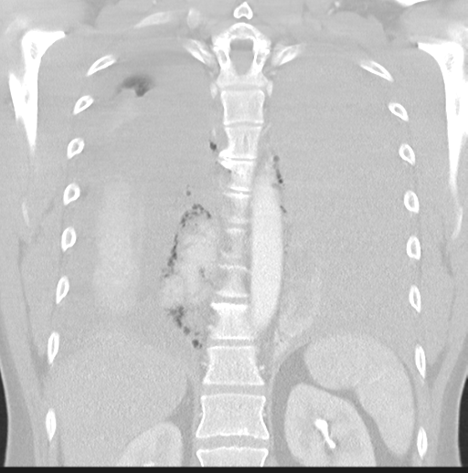 Boerhaave syndrome (Radiopaedia 39382-41661 Coronal lung window 36).png