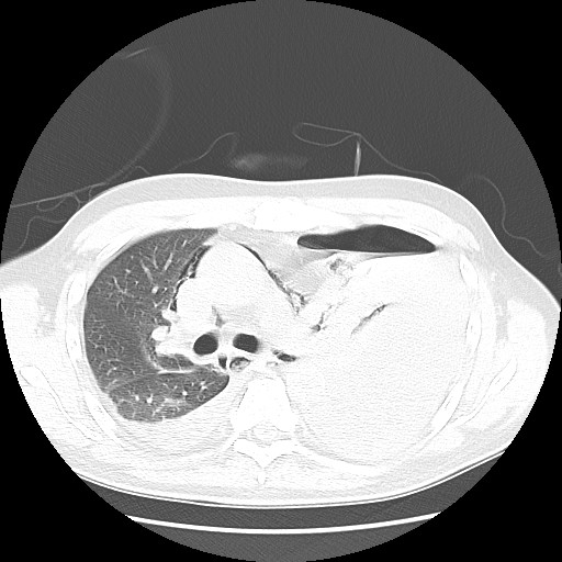 Boerhaave syndrome (Radiopaedia 59796-67310 Axial lung window 27).jpg