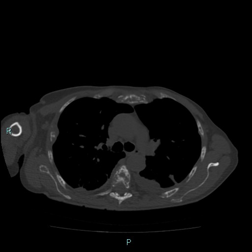 Bone metastases from untreated breast cancer (Radiopaedia 42973-46219 Axial bone window 39).jpg