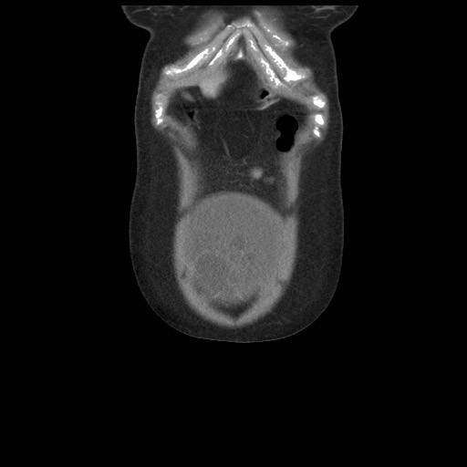 Borderline mucinous tumor (ovary) (Radiopaedia 78228-90808 C 9).jpg