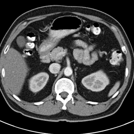 File:Bosniak cyst - type IV (Radiopaedia 23525-23627 renal cortical phase 13).jpg