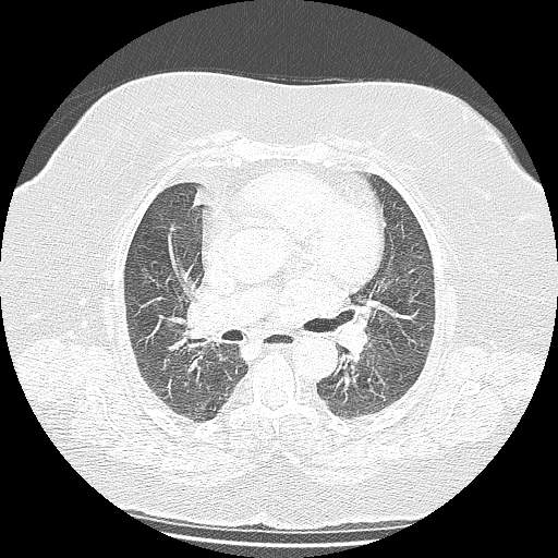 Bovine aortic arch - right internal mammary vein drains into the superior vena cava (Radiopaedia 63296-71875 Axial lung window 73).jpg