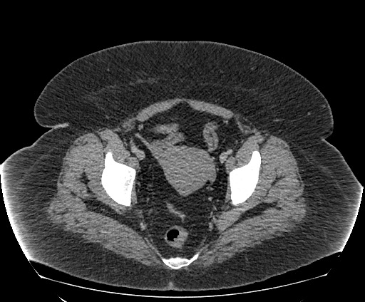 File:Bowel and splenic infarcts in acute lymphocytic leukemia (Radiopaedia 61055-68913 A 111).jpg