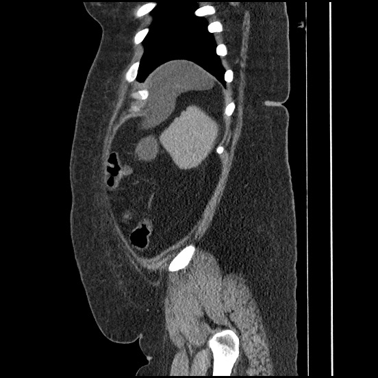 Bowel and splenic infarcts in acute lymphocytic leukemia (Radiopaedia 61055-68913 C 20).jpg