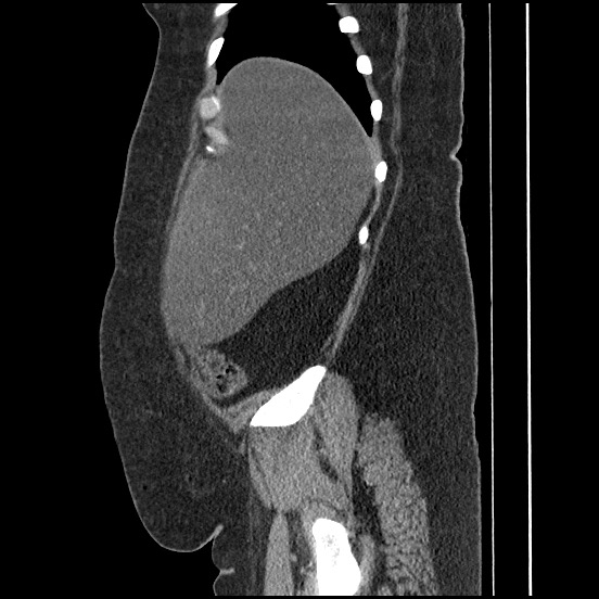 Bowel and splenic infarcts in acute lymphocytic leukemia (Radiopaedia 61055-68913 C 62).jpg