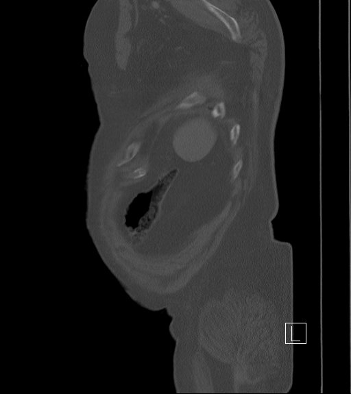 Bowel ischemia secondary to SMA occlusion with extensive portomesenteric venous gas (Radiopaedia 54656-60871 Sagittal bone window 7).jpg