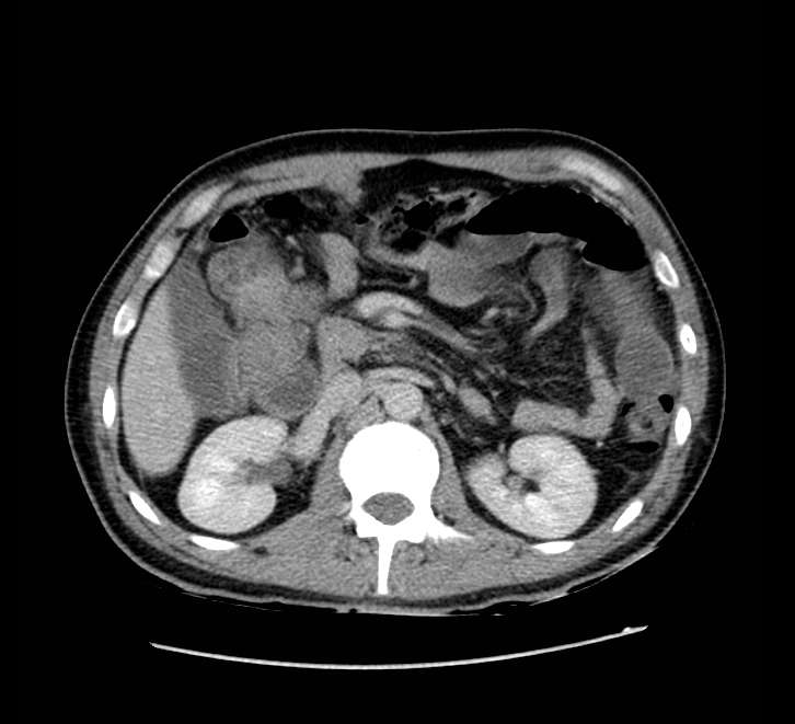 Bowel obstruction from colon carcinoma (Radiopaedia 22995-23028 A 30).jpg
