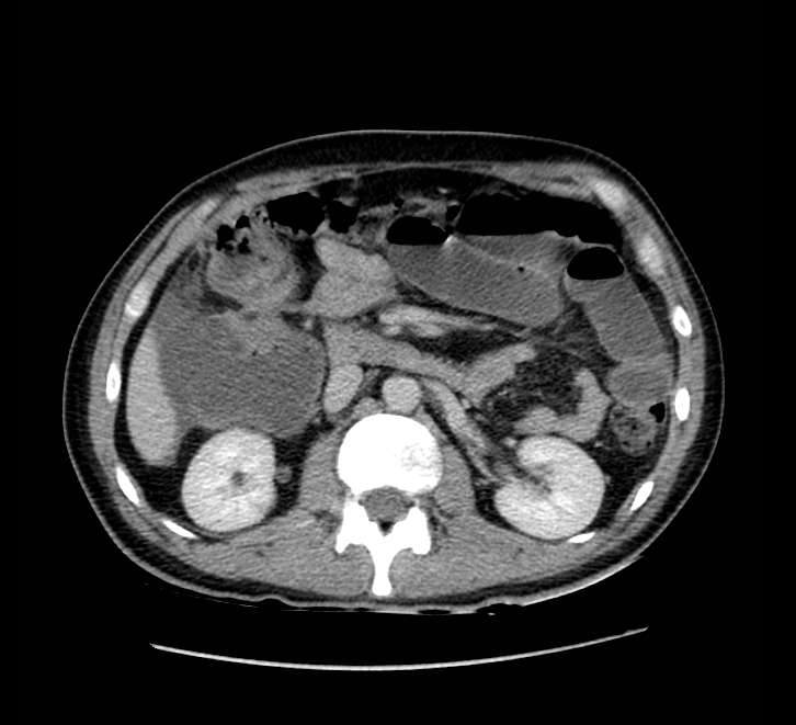 Bowel obstruction from colon carcinoma (Radiopaedia 22995-23028 A 33).jpg