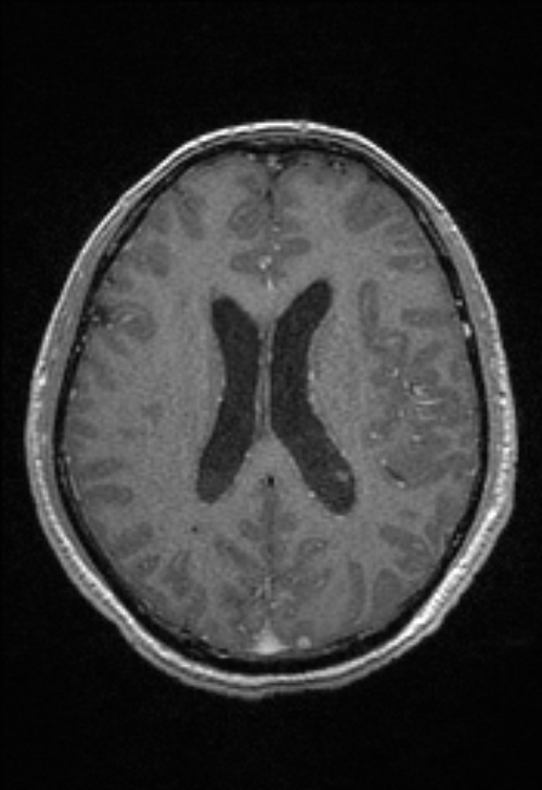 Brain abscess with ventriculitis (Radiopaedia 85703-101495 Axial T1 C+ 110).jpg