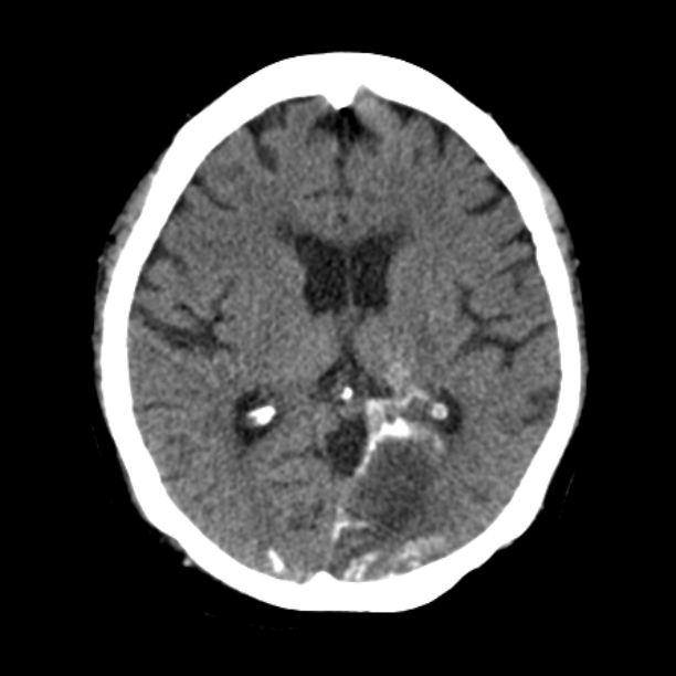 Brain cortical laminar necrosis (Radiopaedia 25822-25971 Axial non-contrast 24).jpg