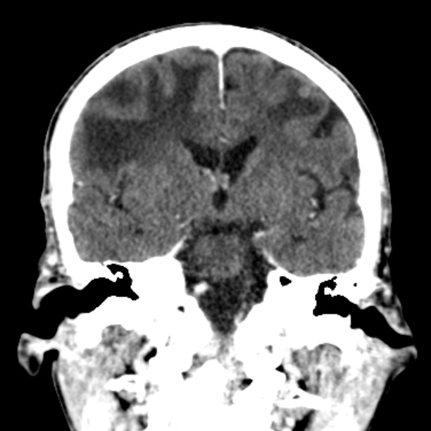 Brain metastases from lung cancer (Radiopaedia 27849-28092 Coronal C+ delayed 33).jpg