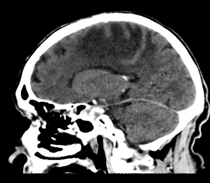 Brain metastases from lung cancer (Radiopaedia 27849-28092 Sagittal C+ delayed 26).jpg