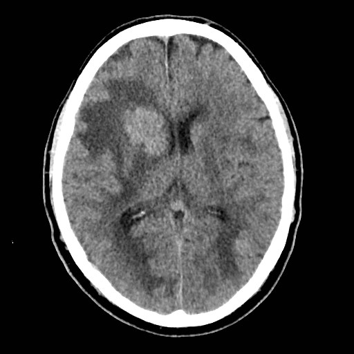 File:Brain metastases from lung cancer (Radiopaedia 83839-99027 Axial non-contrast 19).jpg