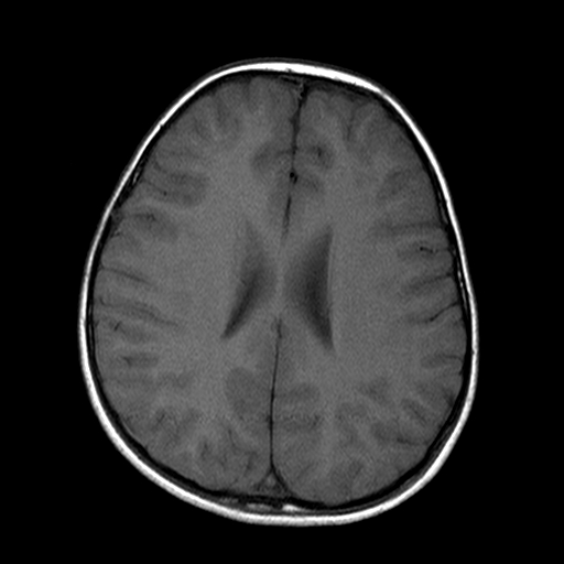 File:Brainstem ganglioglioma (Radiopaedia 10763-11224 Axial T1 7).jpg