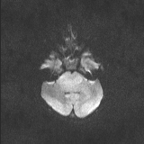 Brainstem glioma (Radiopaedia 67531-76922 Axial DWI 53).jpg