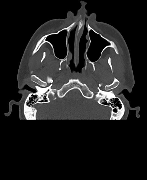 Branchial cleft cyst (Radiopaedia 31167-31875 Axial bone window 9).jpg