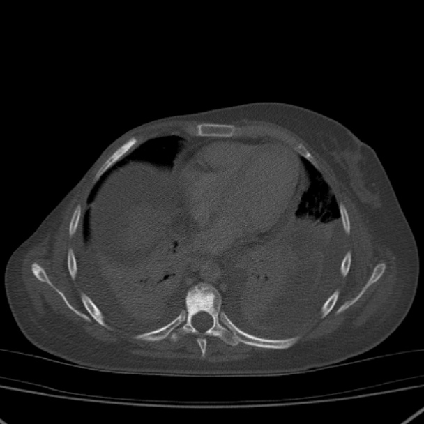 Breast cancer metastases - hepatic and skeletal (Radiopaedia 34201-35461 Axial bone window 24).jpg