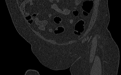 File:Breast carcinoma with pathological hip fracture (Radiopaedia 60314-67993 Coronal bone window 42).jpg