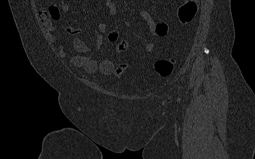Breast carcinoma with pathological hip fracture (Radiopaedia 60314-67993 Coronal bone window 45).jpg
