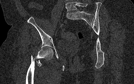 Breast carcinoma with pathological hip fracture (Radiopaedia 60314-67993 Coronal bone window 74).jpg