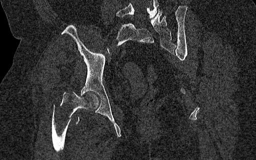 Breast carcinoma with pathological hip fracture (Radiopaedia 60314-67993 Coronal bone window 78).jpg