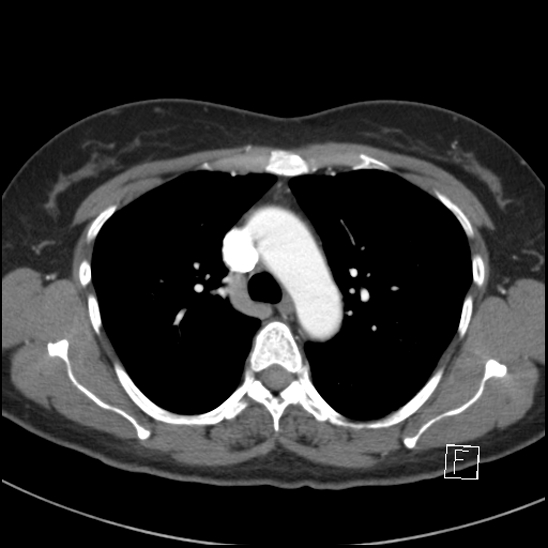 File:Breast metastases from renal cell cancer (Radiopaedia 79220-92225 A 32).jpg