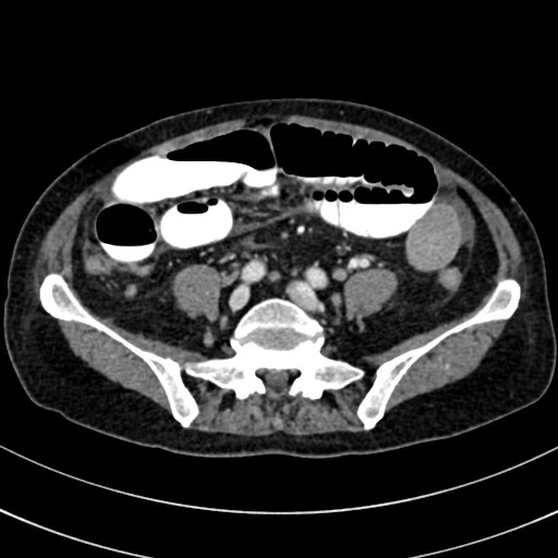 Broad ligament hernia (Radiopaedia 84802-100276 A 70).jpg