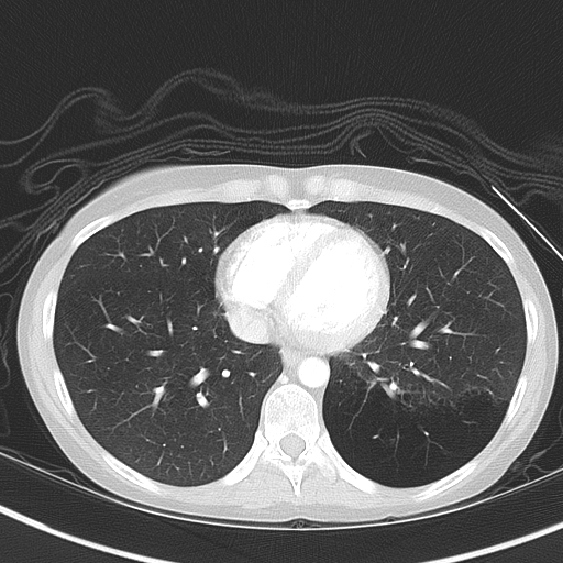 File:Bronchial atresia (Radiopaedia 73677-84470 Axial lung window 42).jpg