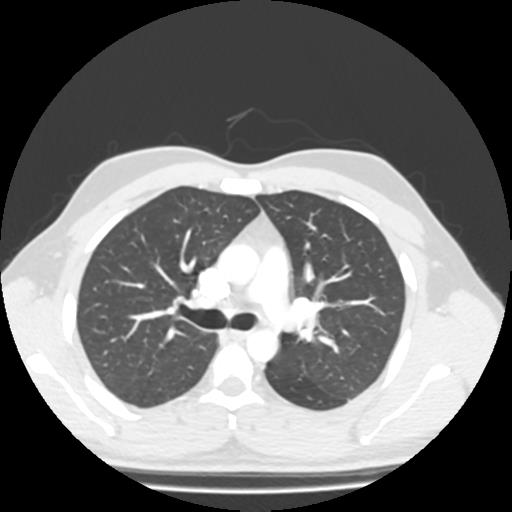 Bronchial carcinoid (Radiopaedia 80013-93291 Axial lung window 40).jpg