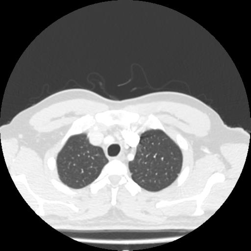 Bronchial carcinoid (Radiopaedia 80013-93291 Axial lung window 7).jpg