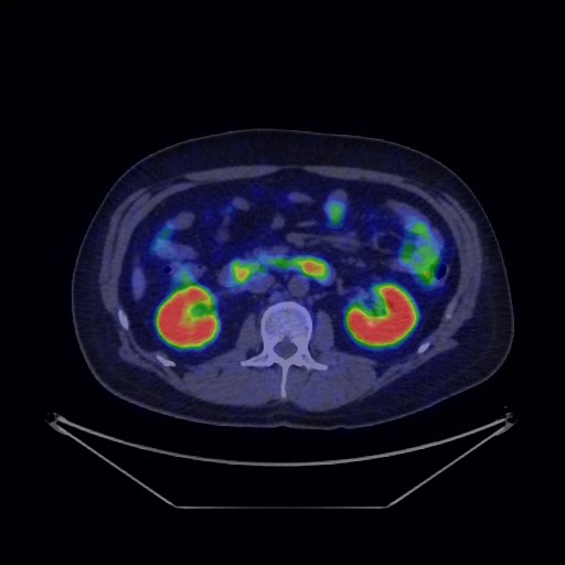 Bronchial carcinoid tumor (Radiopaedia 67377-76765 68Ga-DOTATATE PET-CT 50).jpg