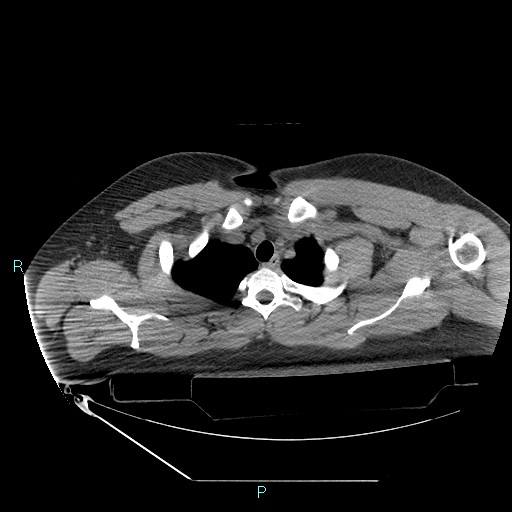 File:Bronchial carcinoid tumor (Radiopaedia 78272-90870 Axial non-contrast 15).jpg