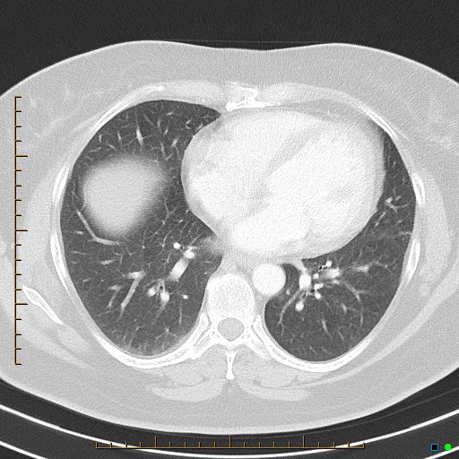 Bronchial diverticula (Radiopaedia 79512-92675 Axial lung window 31).jpg