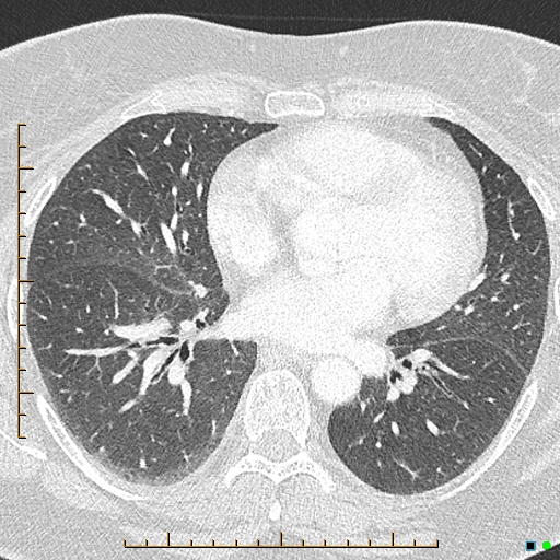 Bronchial diverticula (Radiopaedia 79512-92676 Axial lung window 114).jpg