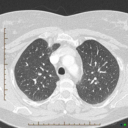 Bronchial diverticula (Radiopaedia 79512-92676 Axial lung window 45).jpg