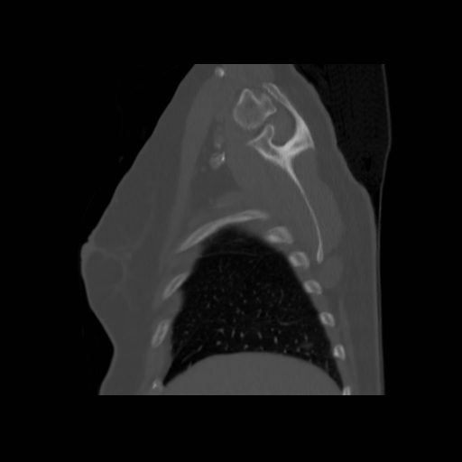 Bronchogenic carcinoma (Radiopaedia 73497-84262 Sagittal bone window 32).jpg
