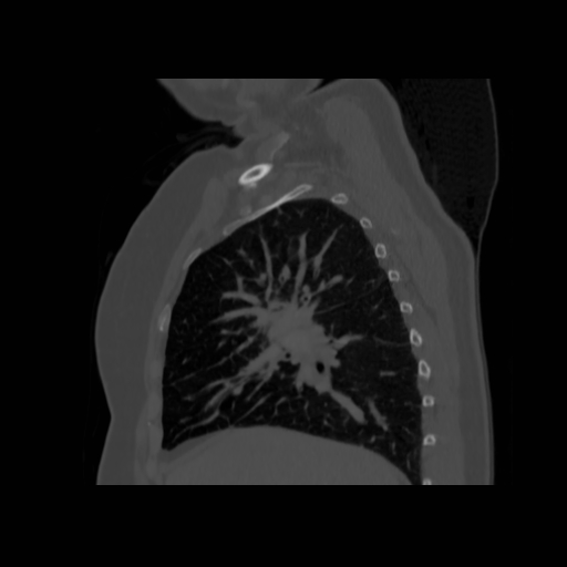 Bronchogenic carcinoma (Radiopaedia 73497-84262 Sagittal bone window 60).jpg