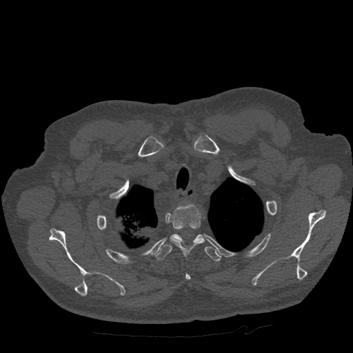 Bronchogenic carcinoma with metastatic lymphadenopathy (Radiopaedia 37671-39569 Axial bone window 8).jpg