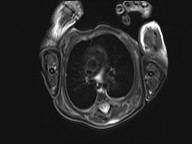File:Bronchogenic cyst (Radiopaedia 27207-27380 Axial STIR 7).jpg