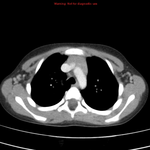 File:Bronchogenic cyst (Radiopaedia 9372-10063 C 4).jpg