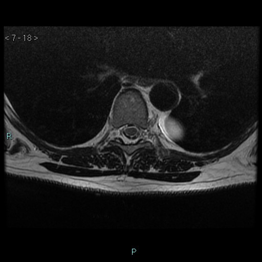 File:Bronchogenic cyst - posterior mediastinal (Radiopaedia 43885-47365 Axial T2 18).jpg