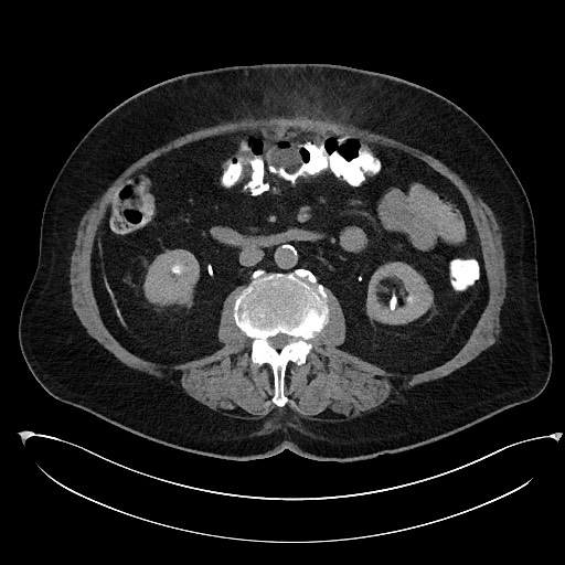 Buried bumper syndrome - gastrostomy tube (Radiopaedia 63843-72577 Axial Inject 51).jpg