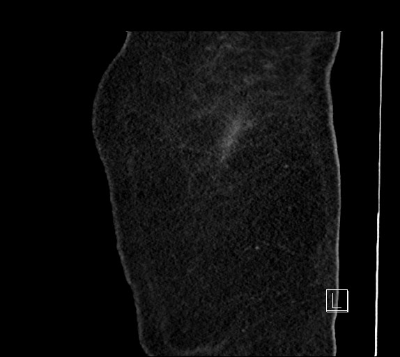 Buried bumper syndrome - gastrostomy tube (Radiopaedia 63843-72577 Sagittal Inject 119).jpg