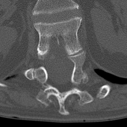 Butterfly vertebrae with kyphoscoliosis (Radiopaedia 14257-14133 Axial bone window 62).jpg