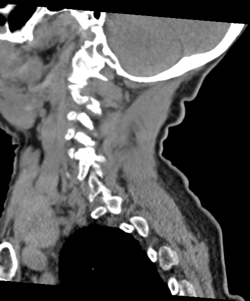 C2 fracture with vertebral artery dissection (Radiopaedia 37378-39199 D 56).png